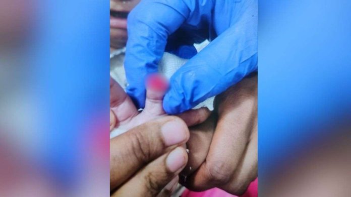 अस्पताल-की-बड़ी-लापरवाही…-ड्रेसिंग-हटाते-समय-काट-दी-6-महीने-के-मासूम-की-उंगली